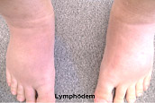 lymphoedem